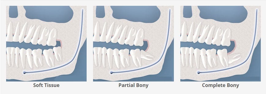 Types of third molar impactions in the jaw