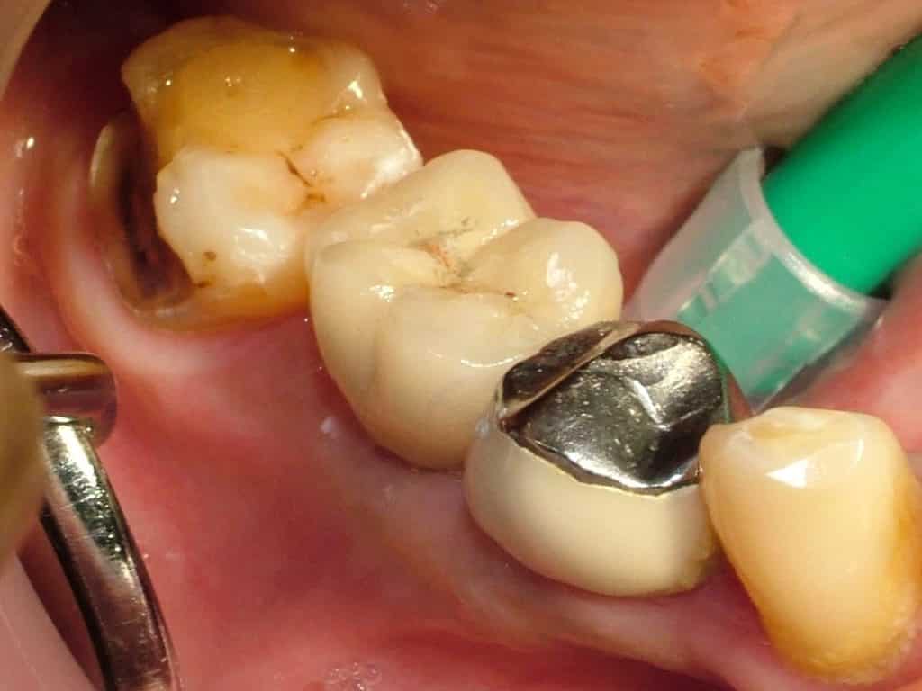 Single tooth Implant with Crown