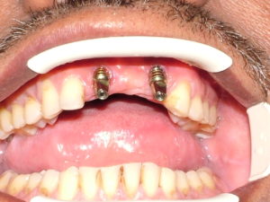 Before Implant crowns
