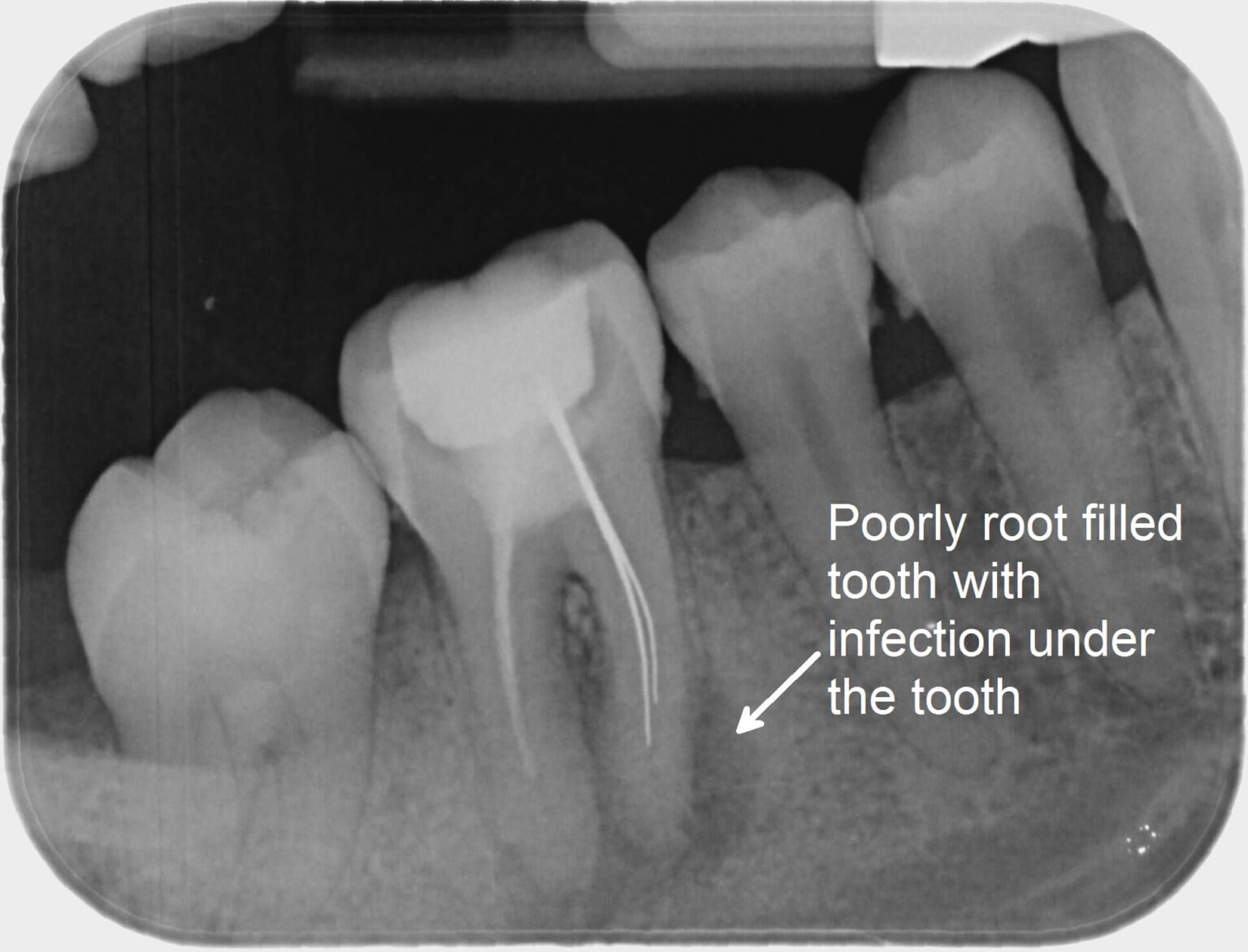 What causes pain after a root canal The Dental Clinic