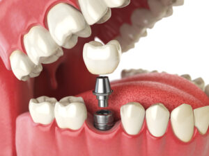 dental implant thane