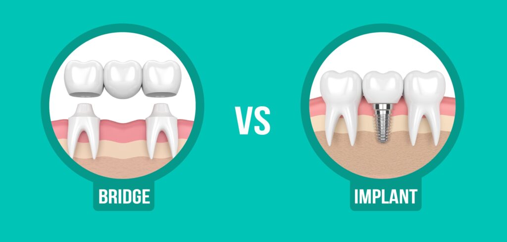 Dental Implant vs Dental Bridge