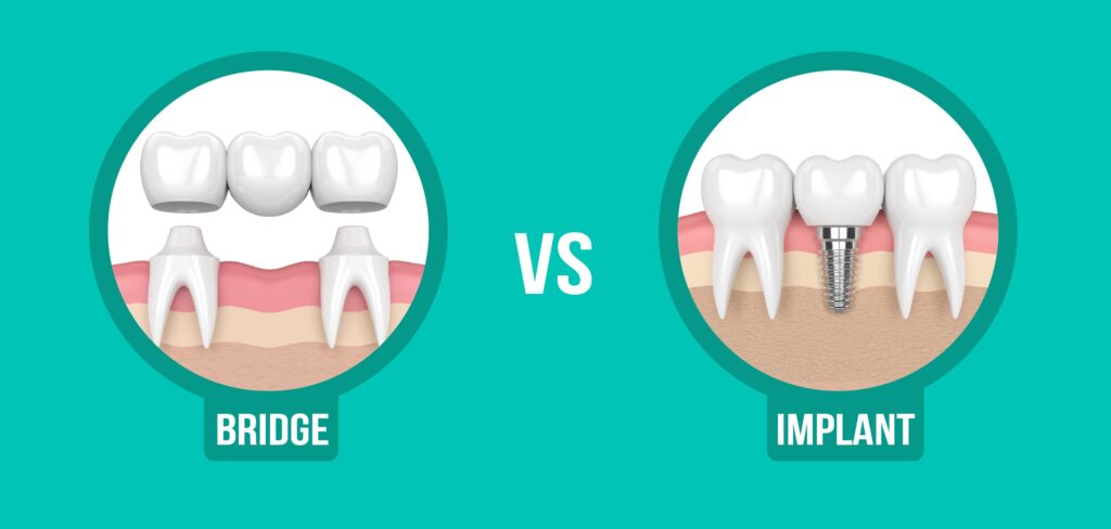 dental bridges vs implants