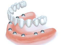 all-on-8-dental-implants