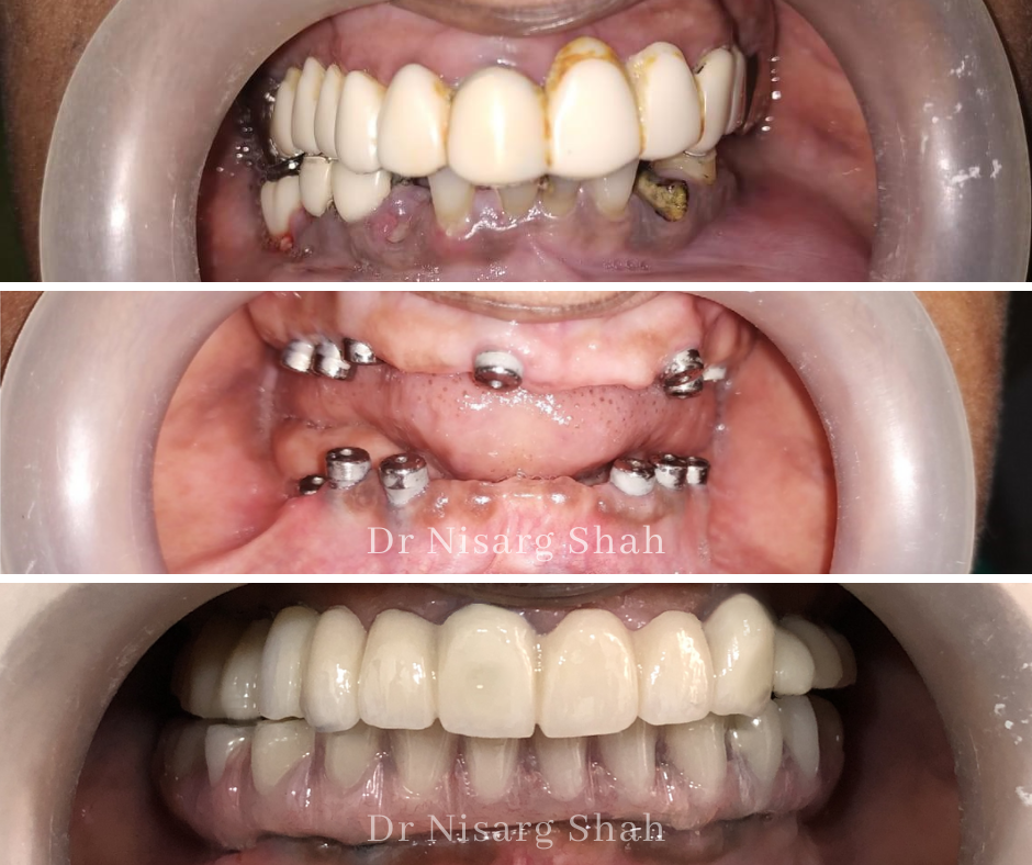 Before after Full mouth rehab