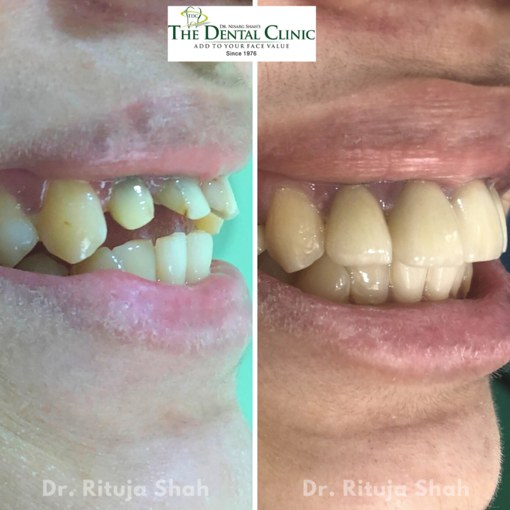 smile designing with zirconia crowns