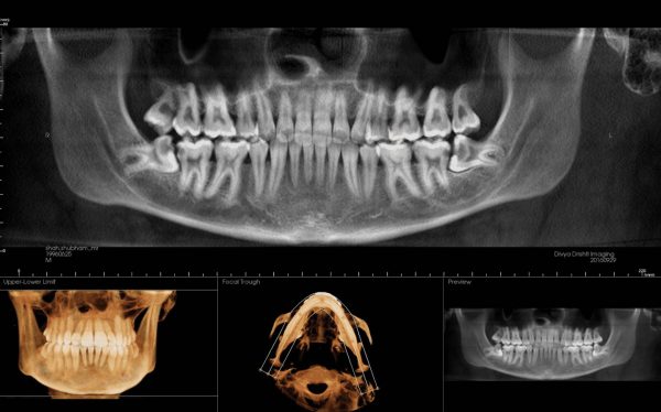 Impacted third molars