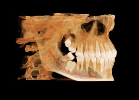 3rd molar shah22