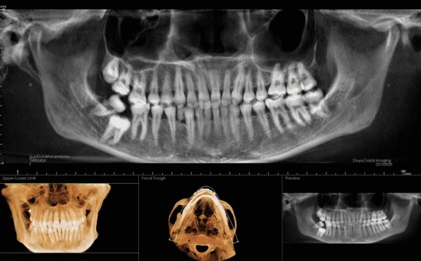 3rd molar shah23