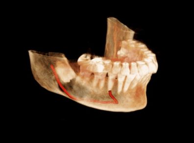 3rd molar shah3