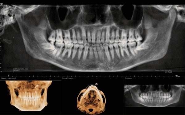3rd molar shah5