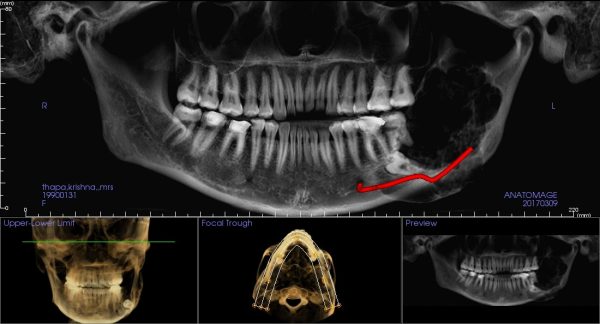 Ameloblastoma