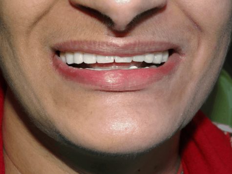 After implant supported Dentures