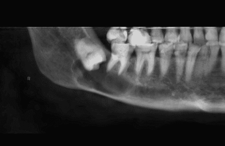 Dentigerous Cyst - Narmada Patel