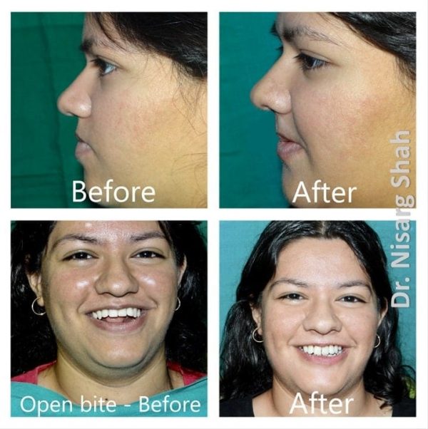 Before/ After images - Orthognathic Surgery - Dr. Nisarg Shah