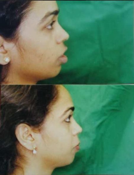 correctjaw shah3