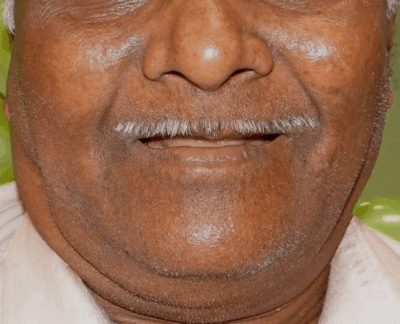 dentures1