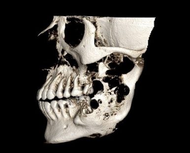 k6 lateral view