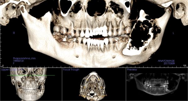 k8 opg in bone rendering