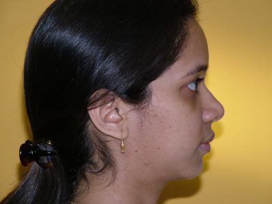 After Orthognathic Surgery